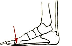 Metatarsalgia Insoles